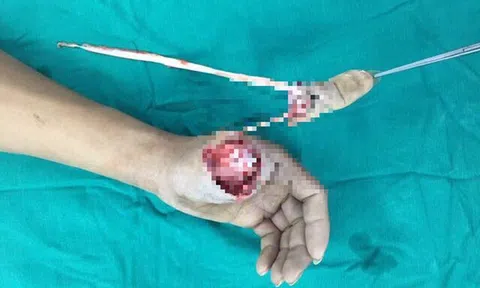 Nam thanh niên bị đứt lìa ngón tay do nổ bình gas